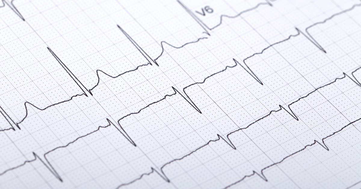 Photocopie des résultats d'un électrocardiogramme